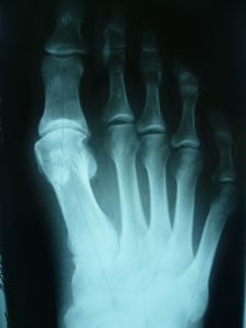 Артрозный hallus valgus